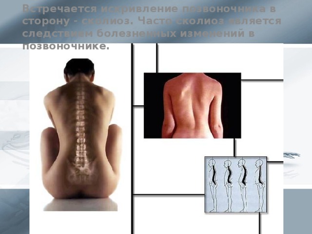 Встречается искривление позвоночника в сторону - сколиоз. Часто сколиоз является следствием болезненных изменений в позвоночнике.