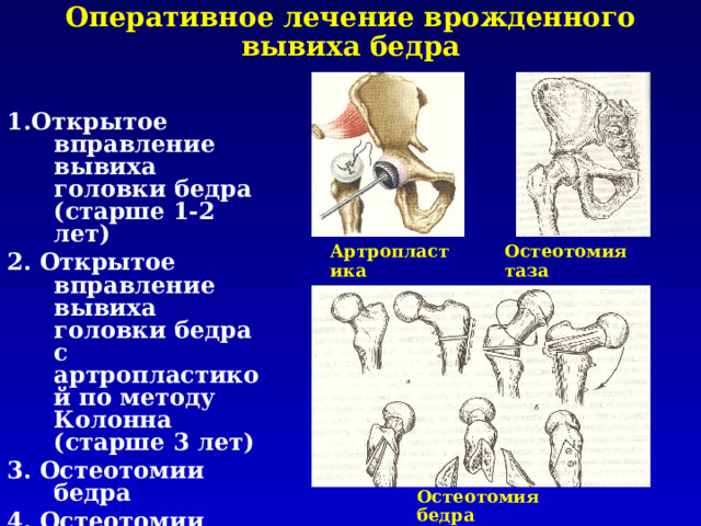 Врожденный вывих бедра