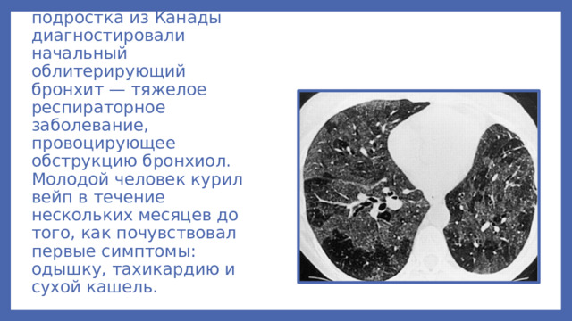 В 2019 году у 17-летнего подростка из Канады диагностировали начальный облитерирующий бронхит — тяжелое респираторное заболевание, провоцирующее обструкцию бронхиол. Молодой человек курил вейп в течение нескольких месяцев до того, как почувствовал первые симптомы: одышку, тахикардию и сухой кашель.